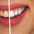dents blanches