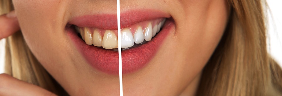 Comment avoir de belles dents blanches au naturel ?